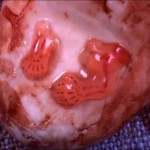 Aborted Embryo - 7 Weeks From Fertilization
