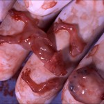 Aborted Embryo - 8 Weeks From Fertilization