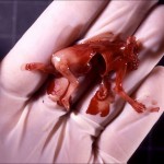 Aborted Fetus - 11 Weeks From Fertilization