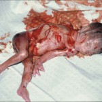 Aborted Fetus - 24 Weeks From Fertilization