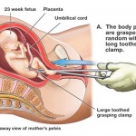 D & E Abortion Illustration 1