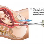 D & E Abortion Illustration 2