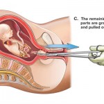 D & E Abortion Illustration 3