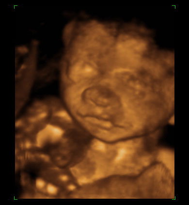 Prenatal Development - Abort97