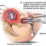 Suction Abortion Illustration 1