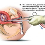 Suction Abortion Illustration 2